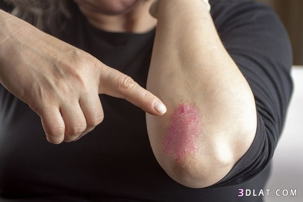 علاج حساسية الجلد بالزيوت الطبيعية , علاج حساسية الجلد بطرق طبيعيه