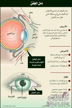 كيف يتم علاج دمل جفن العين ؟؟؟؟