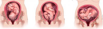 بالصور الولادة القيصرية تعريفها واسبابه