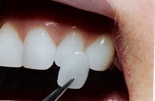 العدسات اللاصقة للاسنان احدث تقنية فى طب الاسنان
