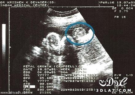 الأشعة الصوتية أثناء الحمل تحول الجنين الذكر من أيمن إلى أعسر