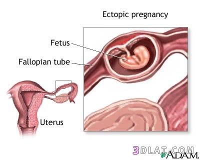 الحمل خارج الرحم