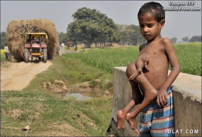 طفل هندى يحمل توأمه الملتصق بصدره 8 سنوات (سبحان الله )