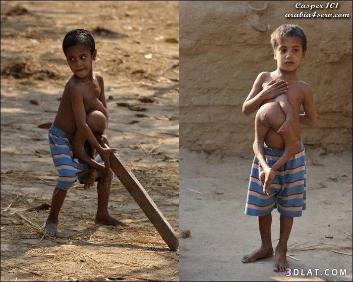 طفل هندى يحمل توأمه الملتصق بصدره 8 سنوات (سبحان الله )