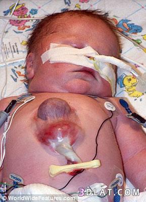 أول صبي في العالم يظل علي قيد الحياة بعد ولادته و قلبه خارج جسمه