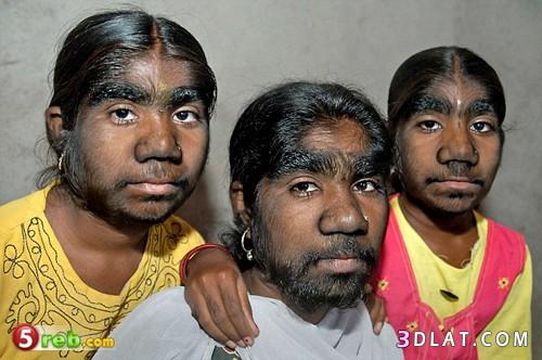 3 فتيات هنديات مصبين بمرض "عرض الذئب"