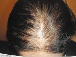 علاج الشعر من ناحية التساقط الفراغات , تكثيف الشعر ,نمو الشعر