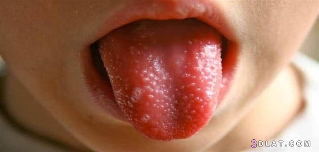كيفية علاج فطريات الفم عند الأطفال ،أسباب فطريات الفم عند الأطفال ،أعراض ف