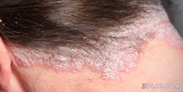 طرق علاج الصدفية في الشعر,أسباب واعراض ظهور الصدفية في الشعر