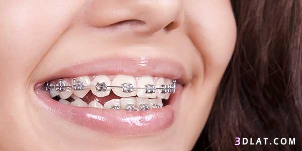 أنواع تقويم الأسنان,نصائح للعناية بالأسنان أثناء التقويم