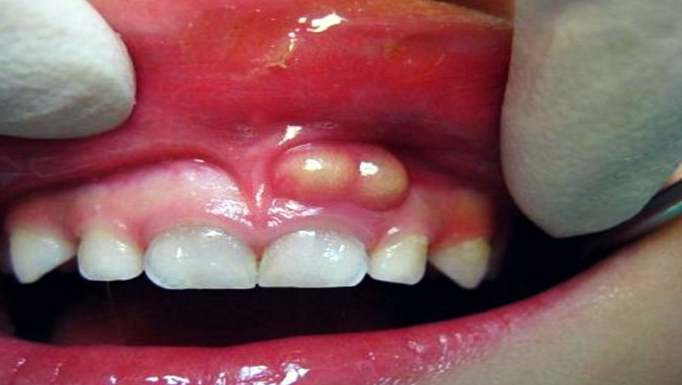 خراج الأسنان،أسباب خراج الأسنان ،أعراض خراج الأسنان ،متى تزور الطبيب،مضاعف