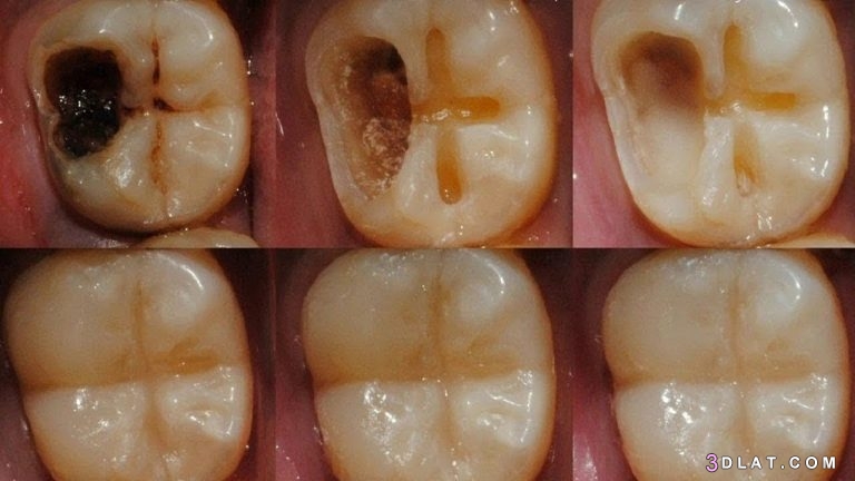 اسباب تسوس الاسنان رغم تنظيفها,علاج تسوس الأسنان,أعراض تسوس الأسنان