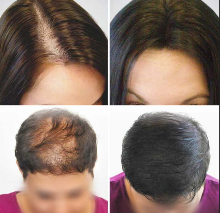 علاج تساقط الشعر للنساء بوصفات طبيعية وأسباب تساقطه.