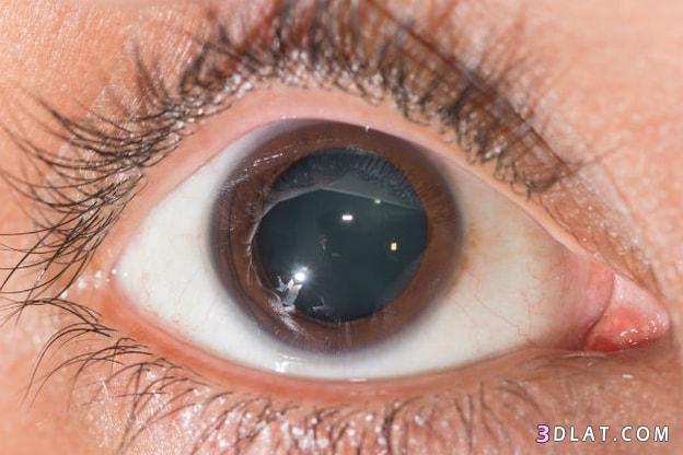 توسّع حدقة العين Mydriasis