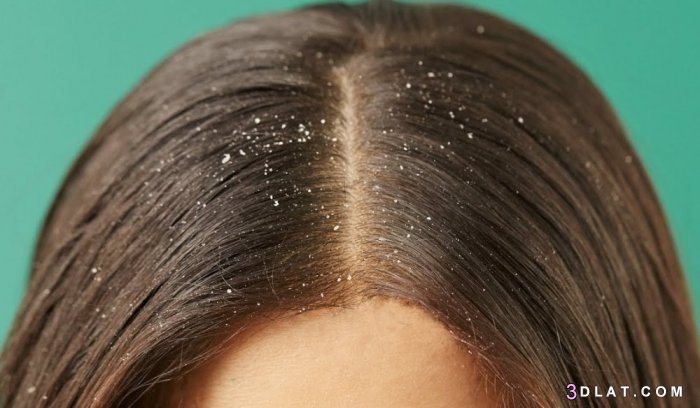 قشرة الشعر،أسباب ظهور القشرة في الشّعر ،كيفية معالجة قشرة الشعر ، وصفات ط