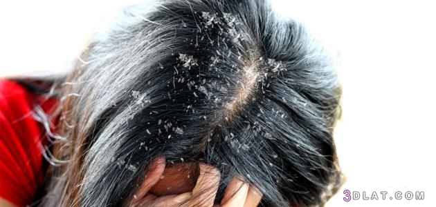 قشرة الشعر،أسباب ظهور القشرة في الشّعر ،كيفية معالجة قشرة الشعر ، وصفات ط