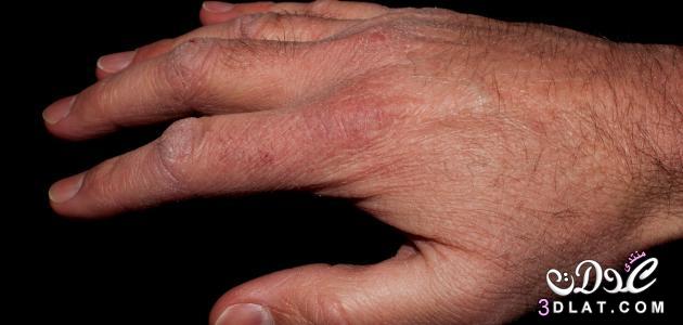 علاج تقشير اليديين وجفافهما في الشتاء, علاج جفاف اليديين بالاعشاب والزيوت