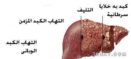 التهاب الكبد أسبابه وأعراضه وأنواعه وعلاجه