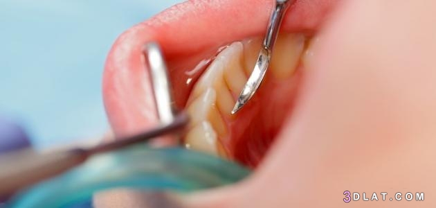 ما هو جير الأسنان ، كيفية إزالة جير الأسنان،أسباب تكون جير الأسنان ،أسباب ض