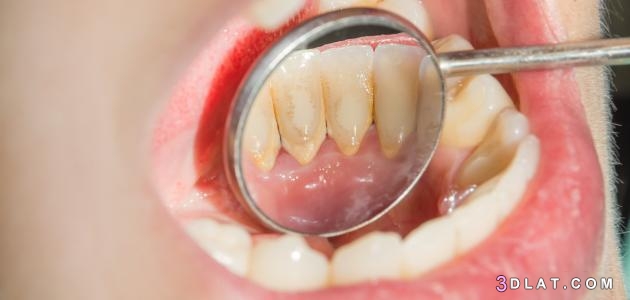ما هو جير الأسنان ، كيفية إزالة جير الأسنان،أسباب تكون جير الأسنان ،أسباب ض