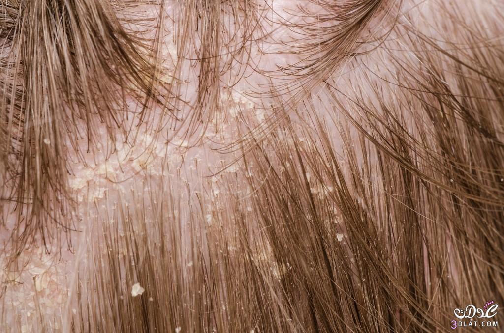 اسباب قشرة الشعر وعلاجها