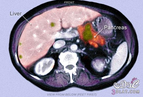 سرطان البنكرياس- الاعراض واسباب وطرق التشخيص