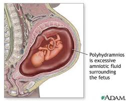 ماهي اسباب زيادة السائل الأمنيوسي حول الجنين عند الحامل