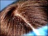 علاج قشره الشعر كيفيه التخلص من القشره المزعجه