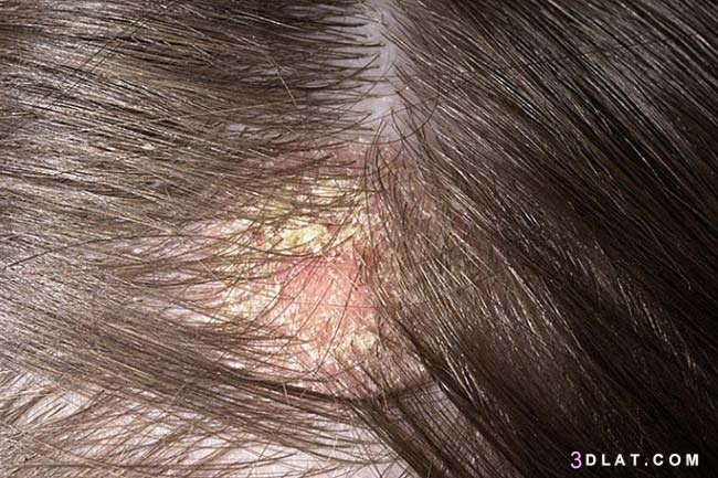 علاج قشرة الشعر وأسباب الإصابة بها