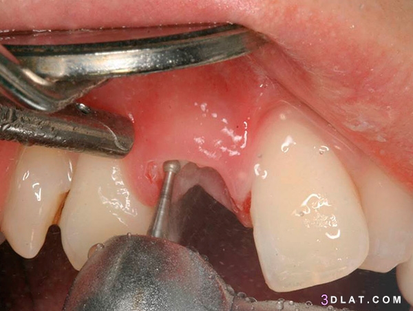 أضرار بقايا جذور الاسنان،أسباب وجود بقايا جذور الأسنان ،أضرار بقايا جذور ا