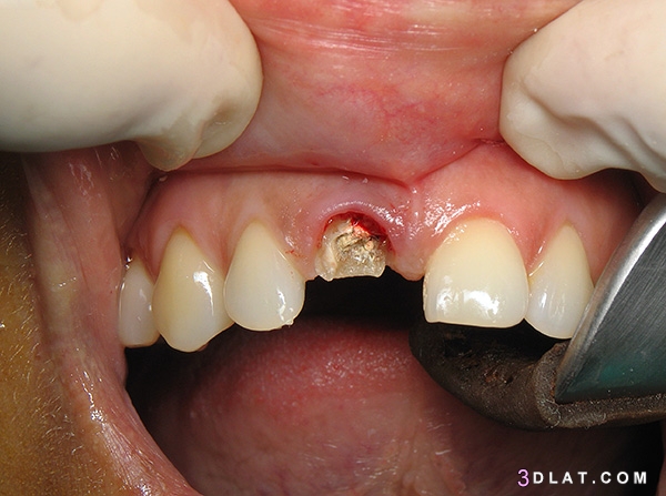 أضرار بقايا جذور الاسنان،أسباب وجود بقايا جذور الأسنان ،أضرار بقايا جذور ا