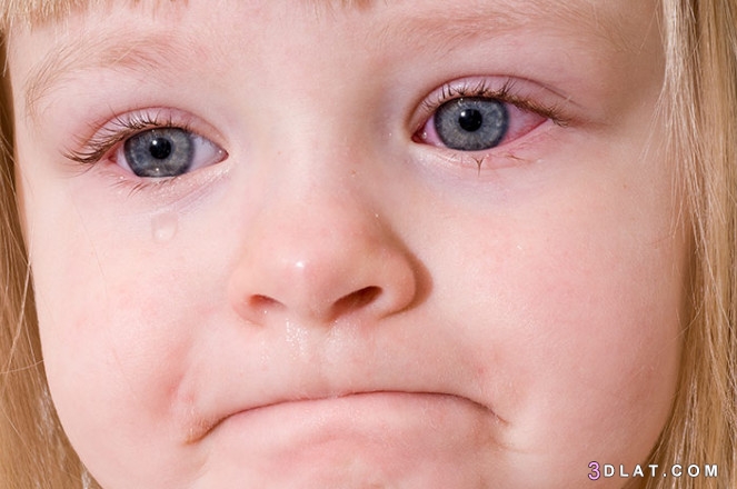 أسباب وعلاج التهاب العين عند الاطفال ،أسباب وعلاج رمض العين عند الاطفال وكي