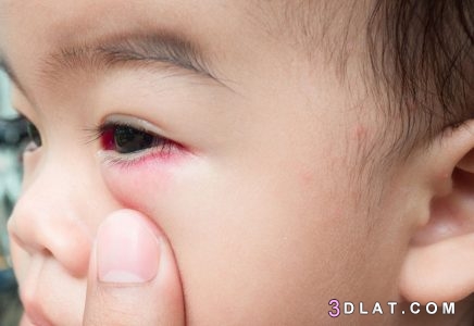 أسباب وعلاج التهاب العين عند الاطفال ،أسباب وعلاج رمض العين عند الاطفال وكي