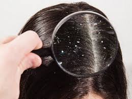 5 نصائح لعلاج قشرة الشعر , علاج   قشرة الشعر بالمنزل , طرق علاج قشرة الشعر