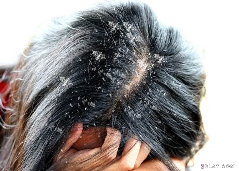 كيف تتعامل مع قشر الشعر وخصوصا في الشتاء