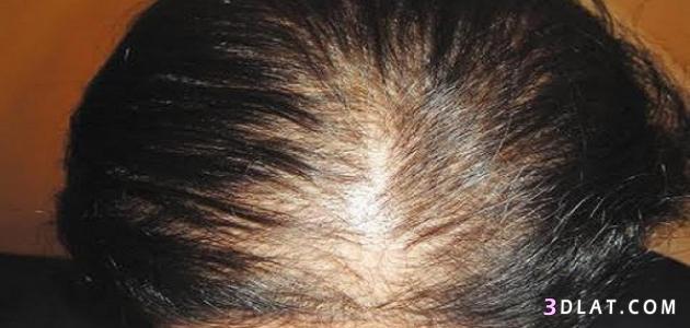 علاج تقصف الشعر من الامام,وصفات لعلاج تقصف الشعر الامامى,طرق حل مشكلة التقص