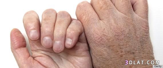 جفاف وتشققات اليدين في الشتاء سببها وعلاجها ،علاج تشقق اليديــن طبياً،علاج تشقق اليد