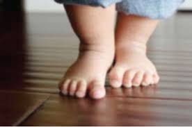 تقوس القدم عند الاطفال المرض الاسباب العلاج الوقاية