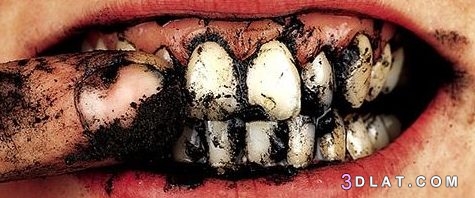 تبييض الأسنان كيفيه تبييضها وما يضر ومالا يضر فيها.