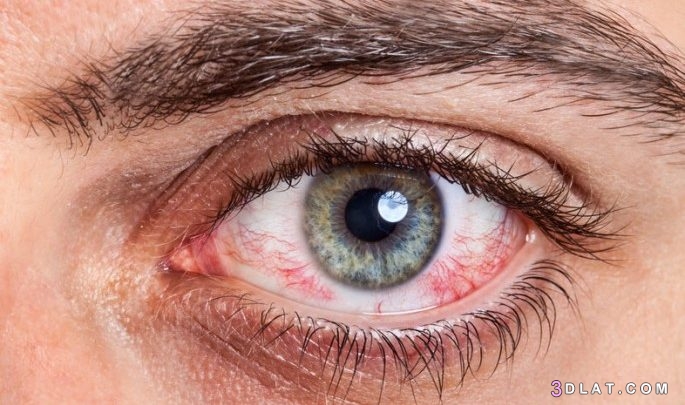 حساسية العين،أسباب حساسيّة العين،أعراض الإصابة بحساسية العين علاج حساسية ا