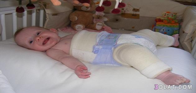 اسباب الخلع للاطفال عند الولاده, كيفيه علاج الخلع للاطفال