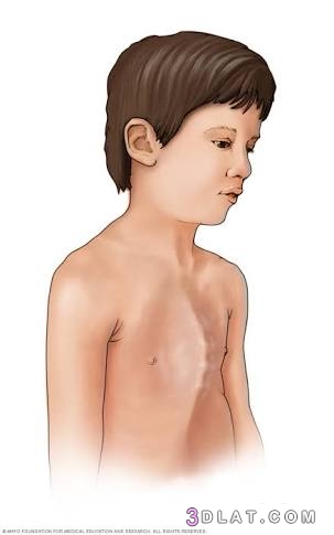 ما هو الصدر الجؤجؤي عند الاطفال، علاج الصدر الجؤجؤي، مواصفات الصدر الجؤجؤي