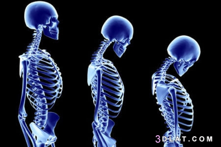 ما هي هشاشة العظام ،هشاشة العظام الأولية،هشاشة العظام الثانوية  أعراض هشاشة