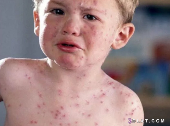 مرض الحصبة Measles ،أسباب مرض الحصبة ، التطعيم ضد الحصبة،تحذيرات تطعيم الحص