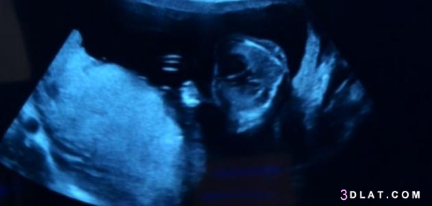 كيس الحمل في الرحم وقت ظهور كيس الحمل حول الجنين متى يظهر كيس الجنين في الس