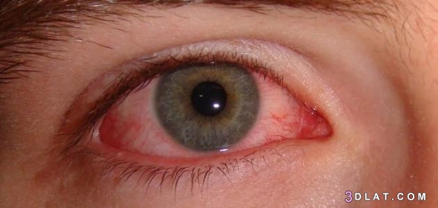 حساسية العين، أسبابها وعلاجها،استعمال قطرات العين التي تناسب تحسس العين.