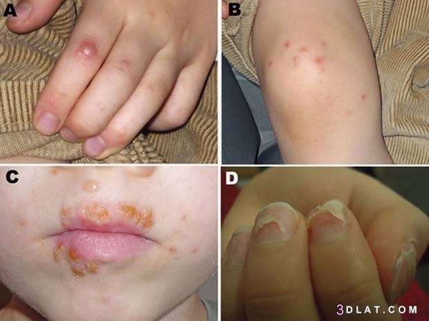 مرض اليد والقدم والفم للاطفال ..الأسباب والمضاعفات ، علاج مرض اليد والقدم