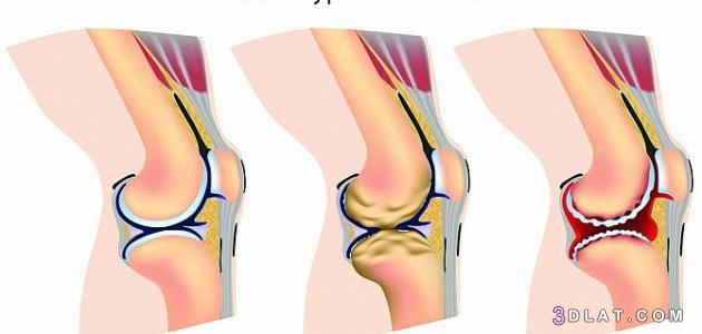 أعراض خشونة الركبة، سبب أعراض خشونة الركبة، طرق علاج أعراض خشونة الركبة 202