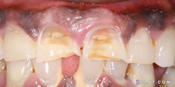 كيفية حماية الأسنان من التآكل