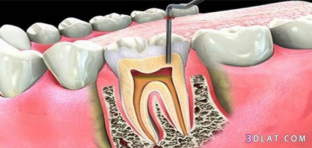 ملف شامل عن التهاب عصب الاسنان,اسباب وطرق علاج عصب الاسنان